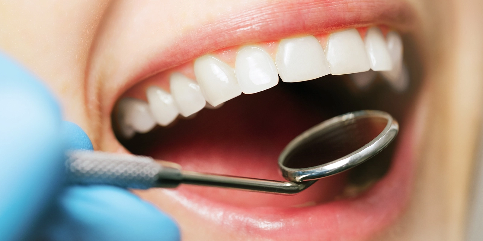 定期的なケアで、健康な歯を守り続ける