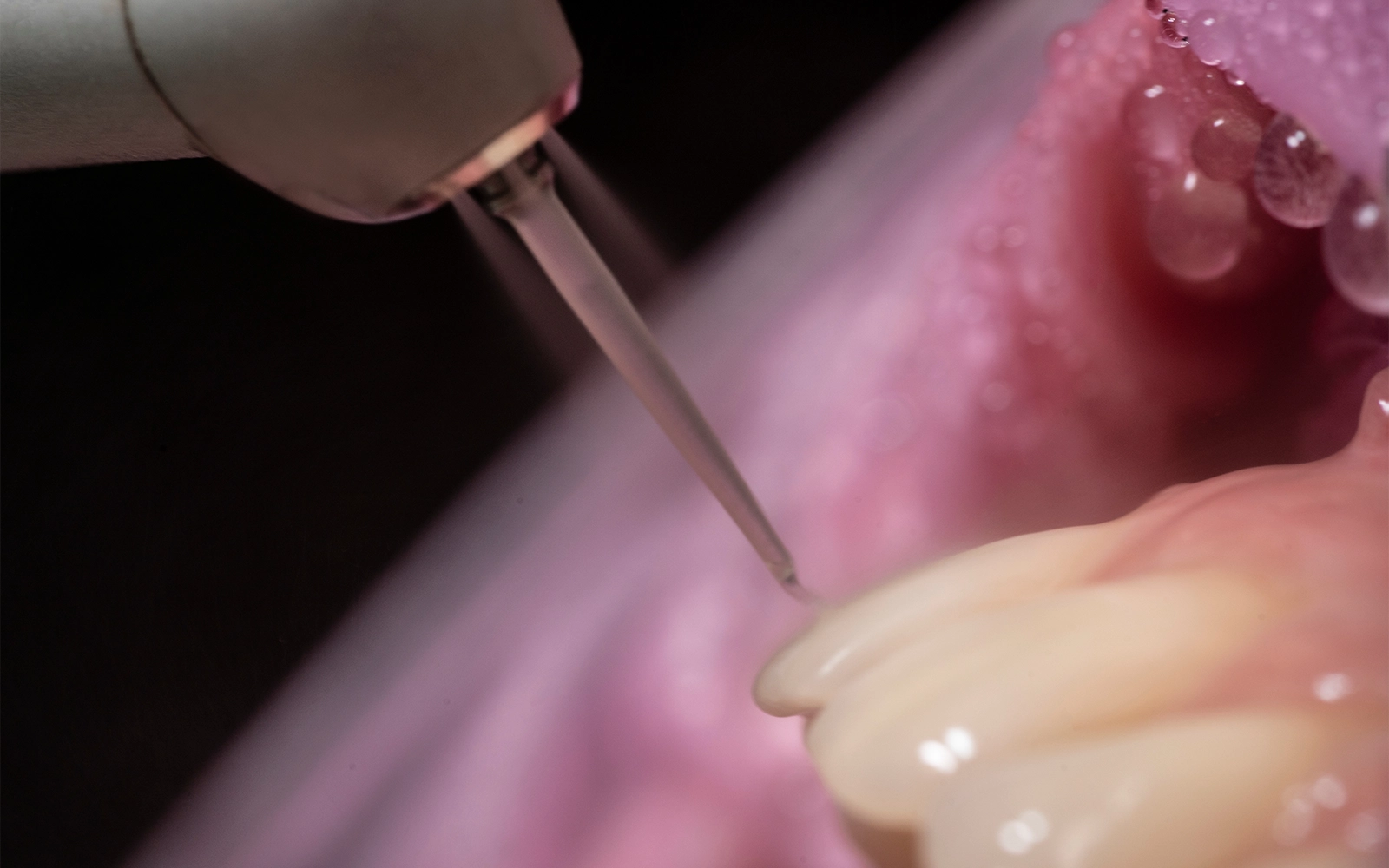 咬合調整・補綴治療