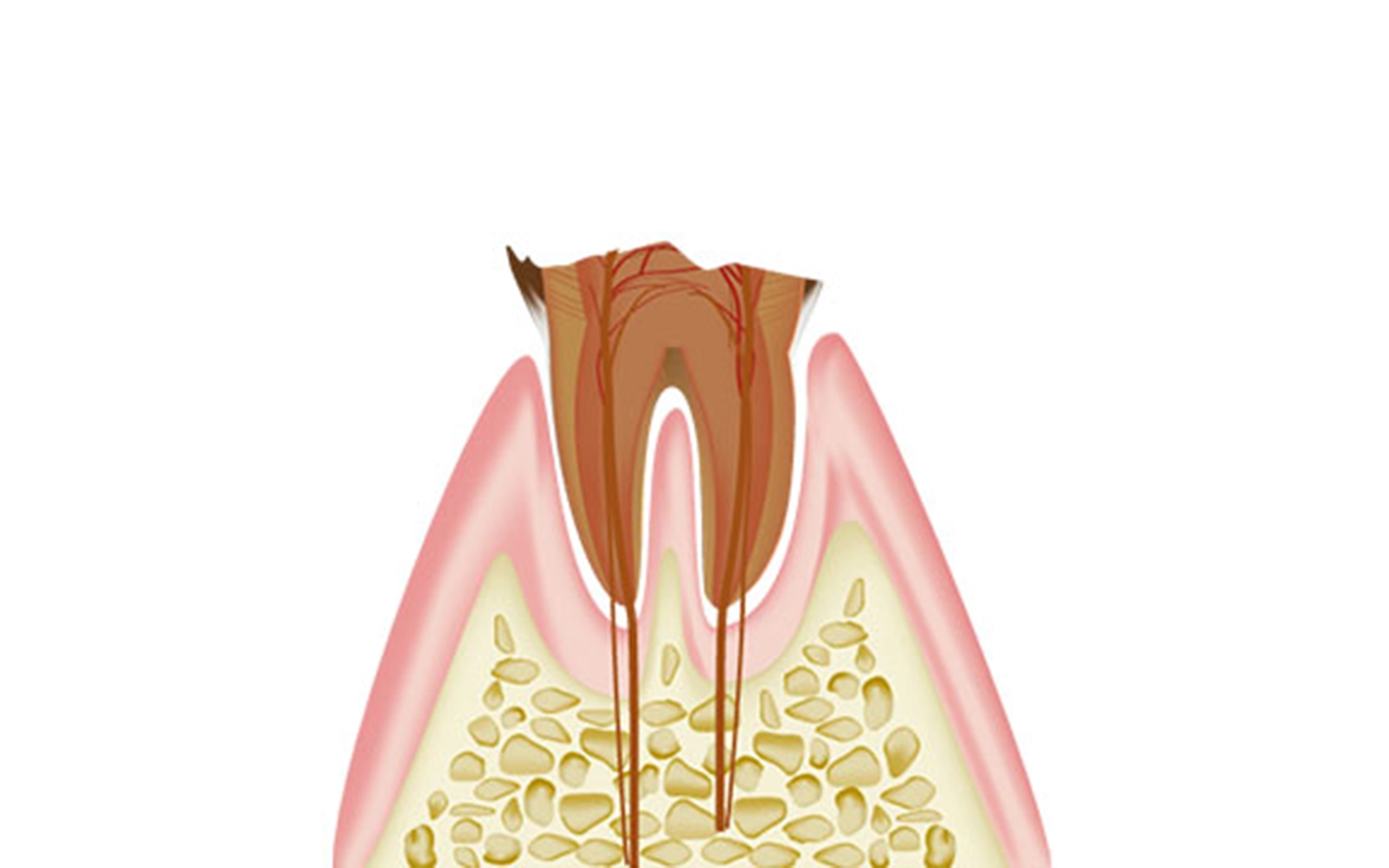C4（歯の大部分が崩壊した状態）