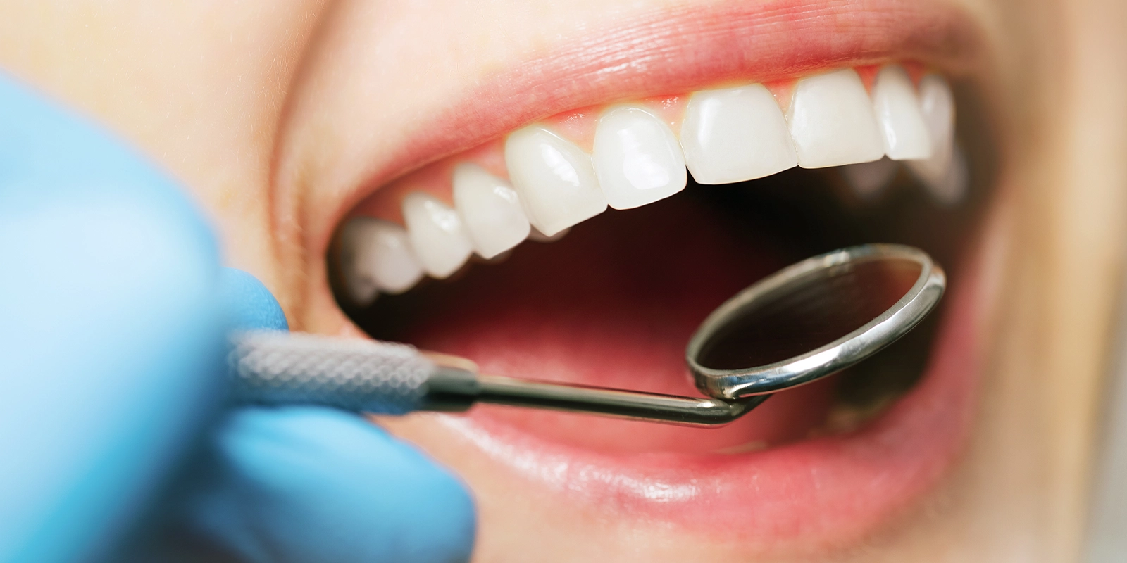 当院の虫歯治療方針