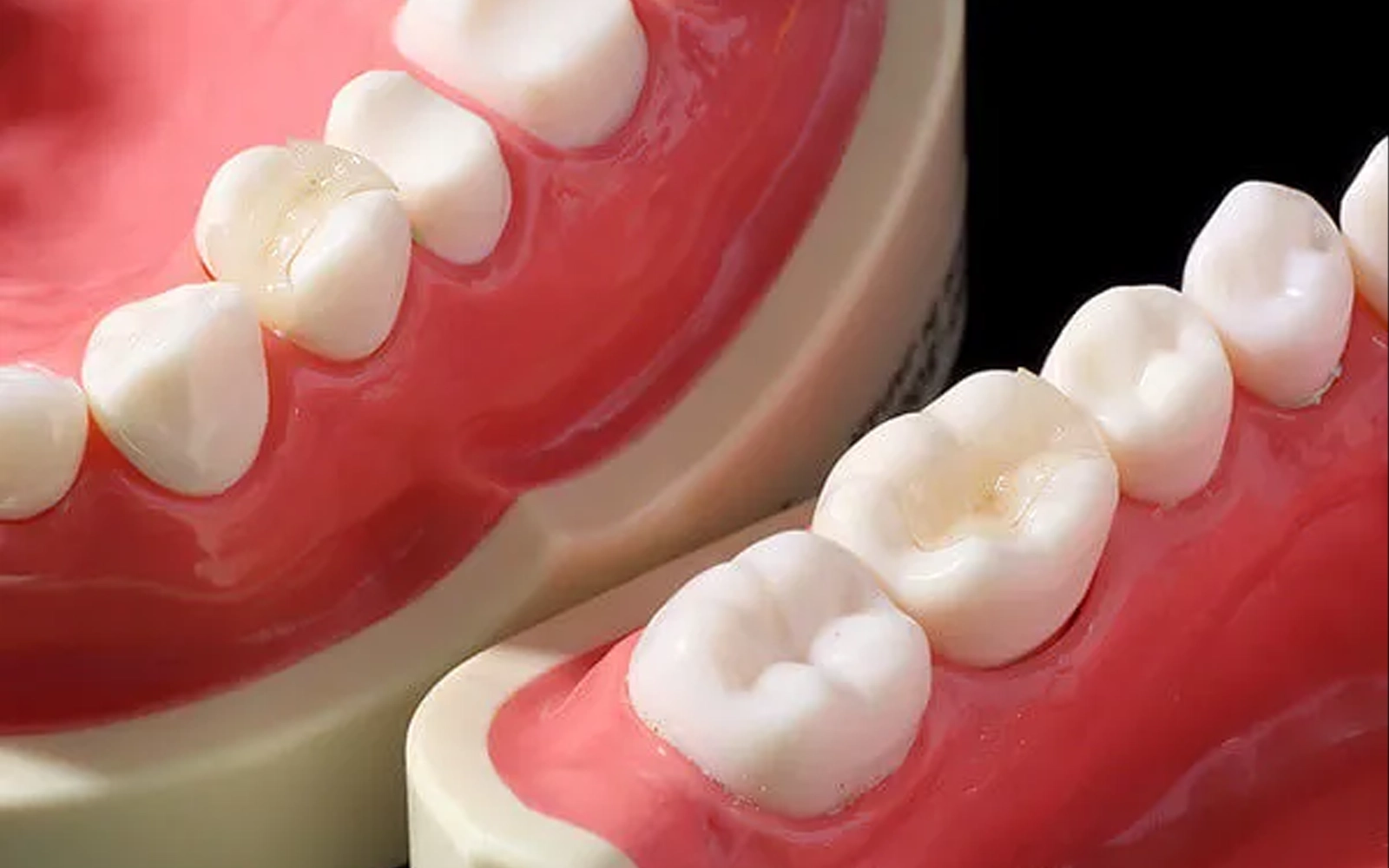 セラミックインレー・アンレー（詰め物）