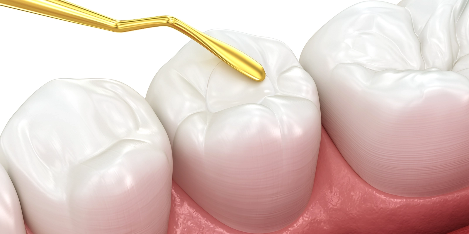 ダイレクトボンディングとは