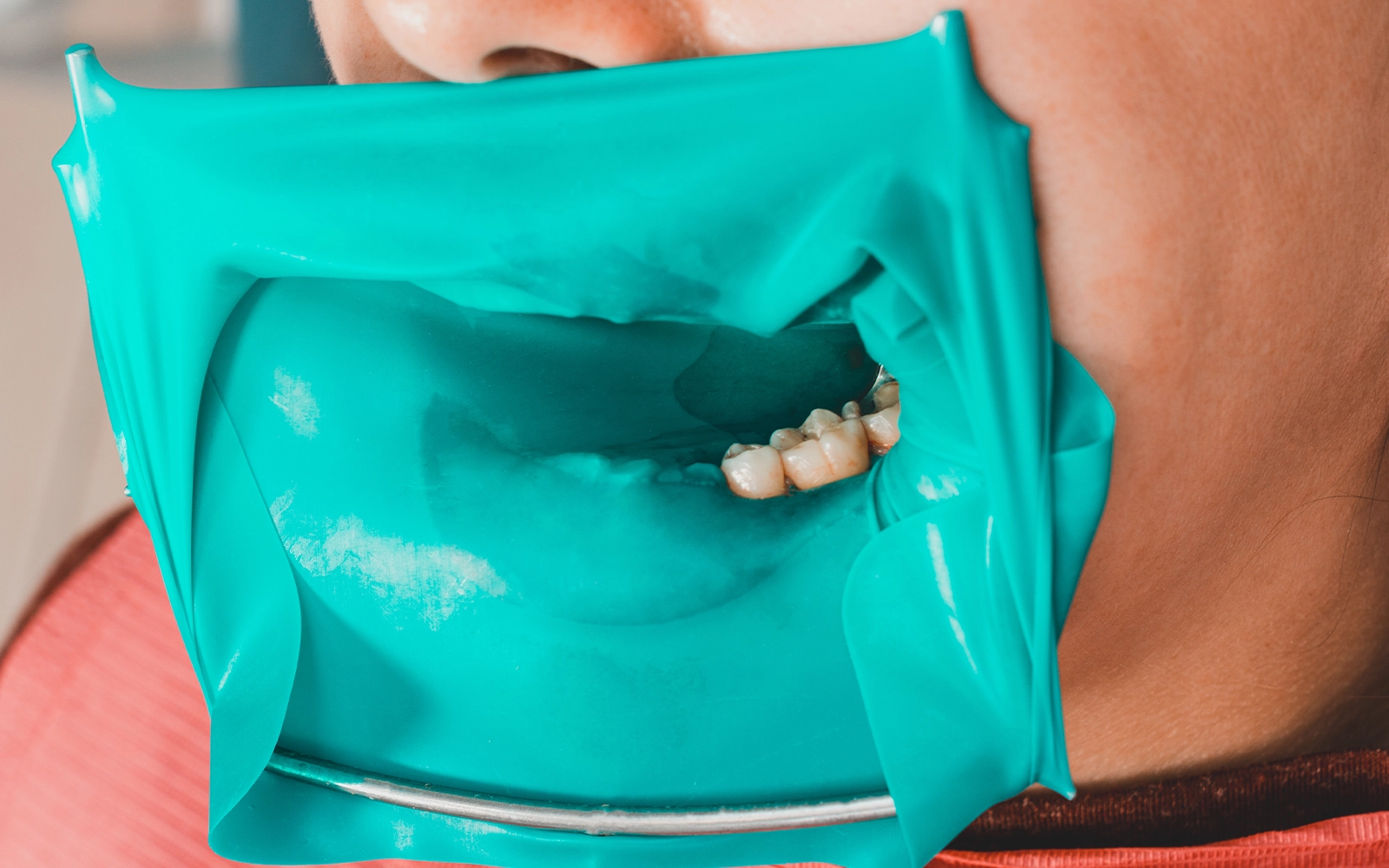 ラバーダム防湿と拡大視野で、接着精度を最大化