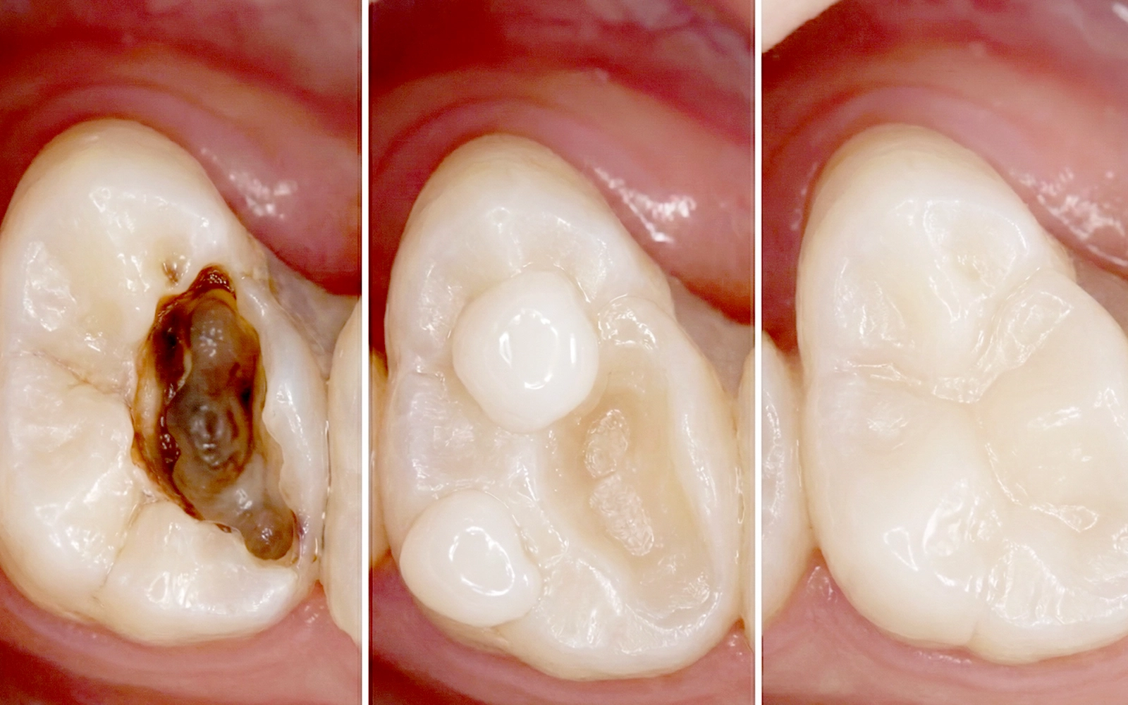 層状築盛で、天然の歯の質感を再現