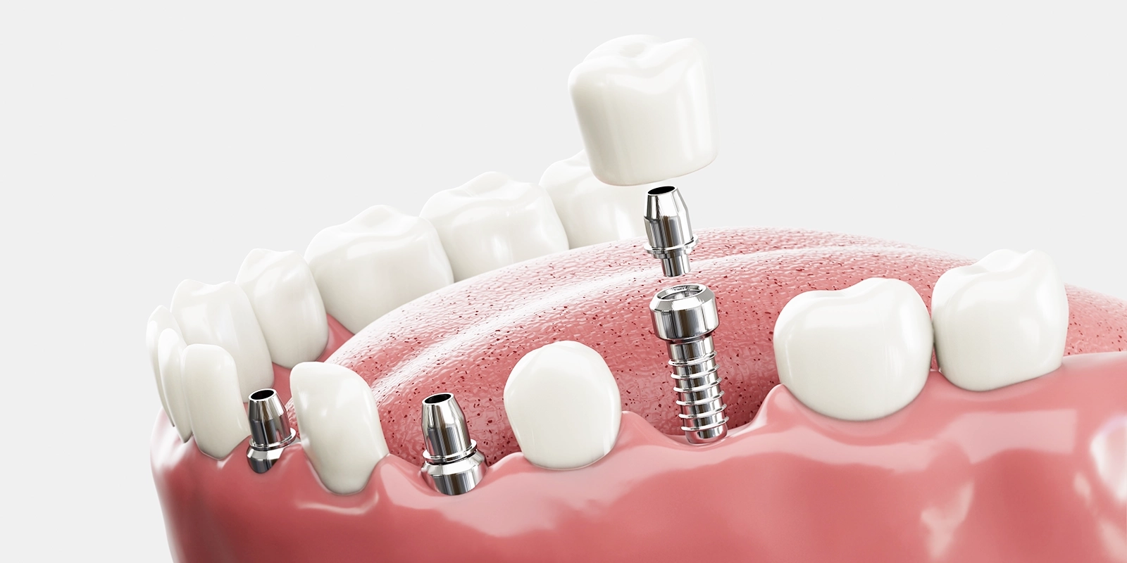 インプラントとは