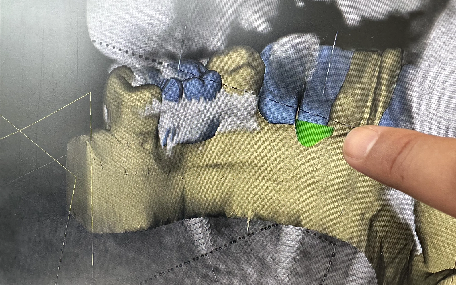 CT撮影とデジタルシミュレーションで手術の精度を高める