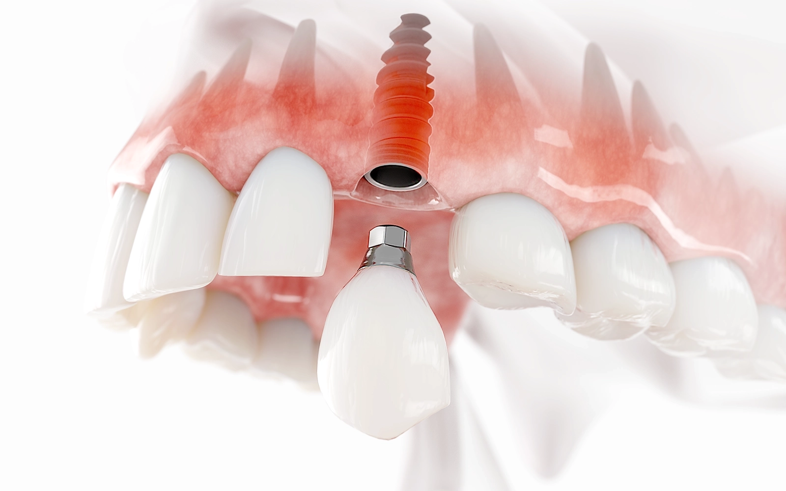 骨とインプラントが結合するまで待つ