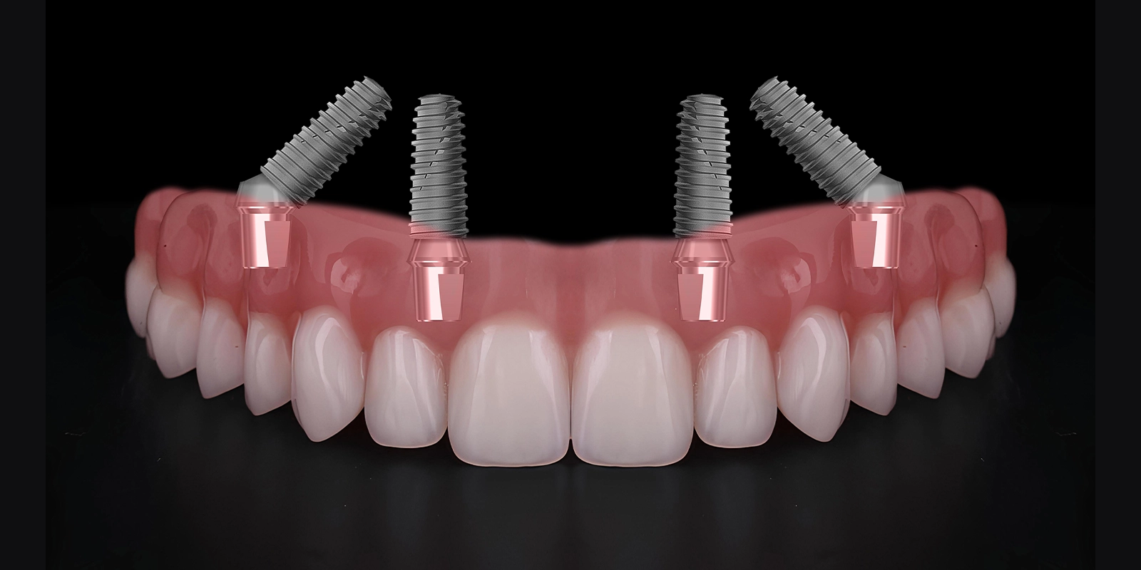 オールオン4（ワンデイインプラント）とは？