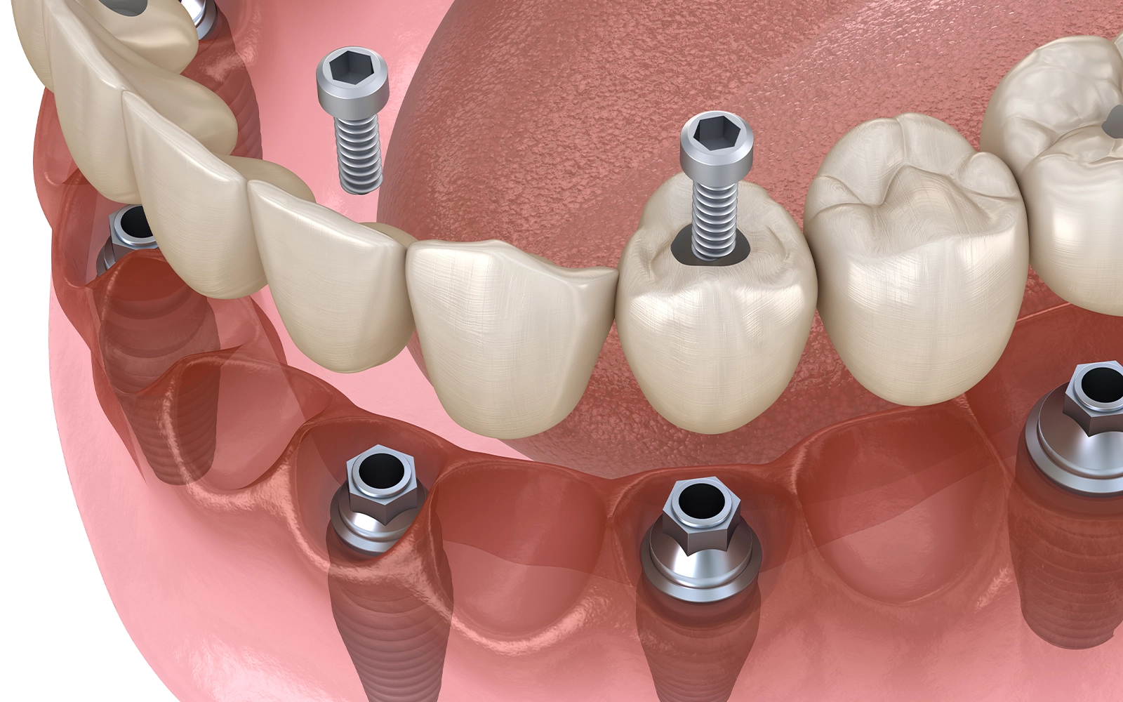 オールオン4の治療経過