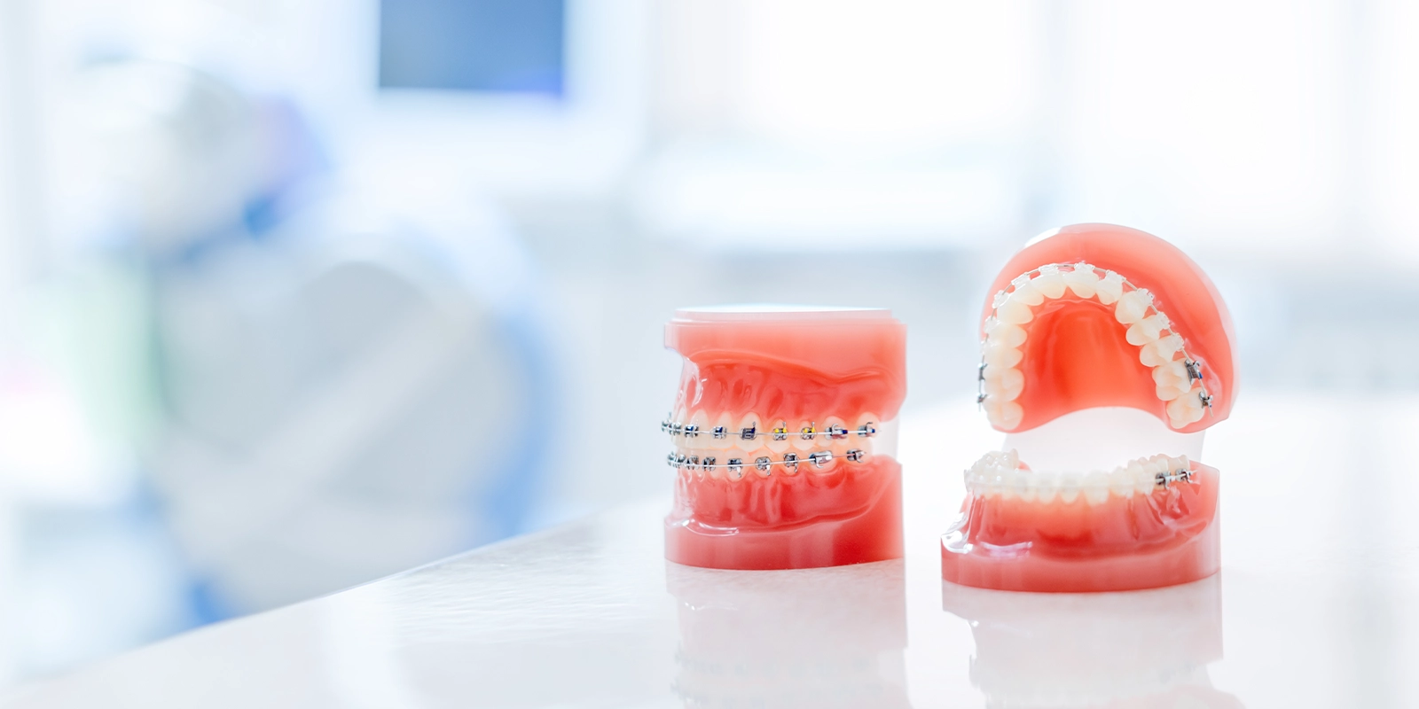 ワイヤー矯正とは