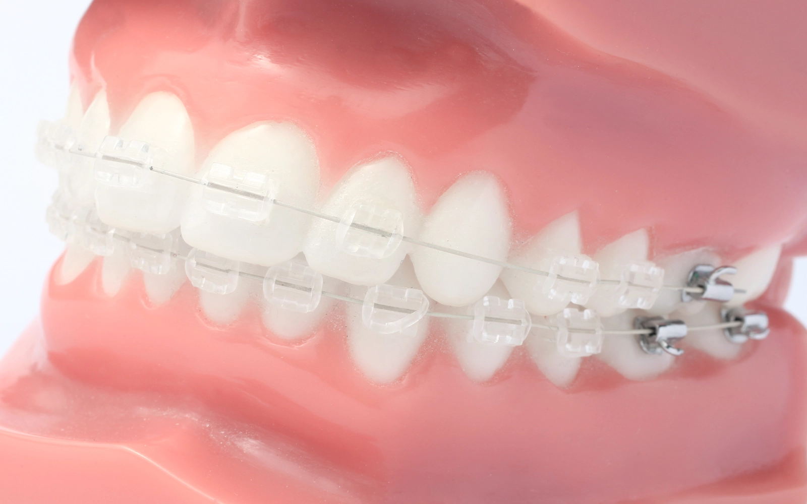 目立ちにくいワイヤー矯正