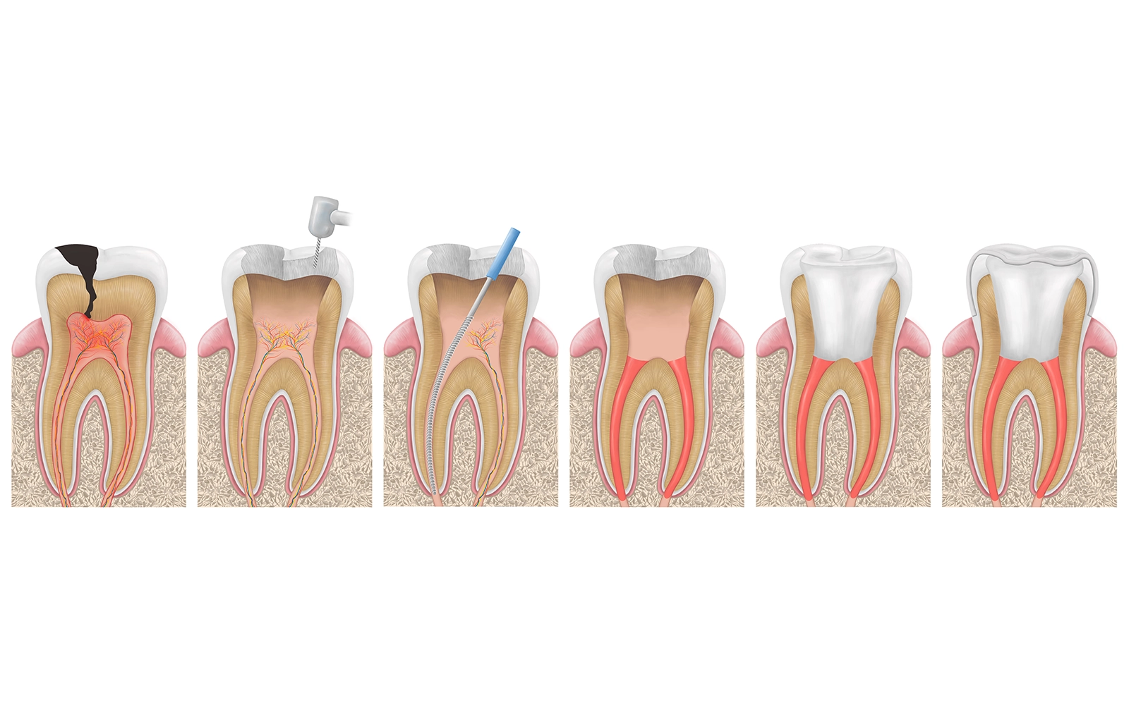 根管治療で行うこと