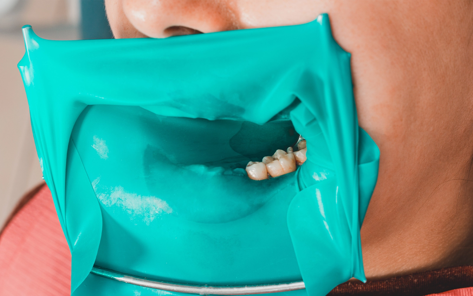 ラバーダム・CT撮影を全症例で標準装備