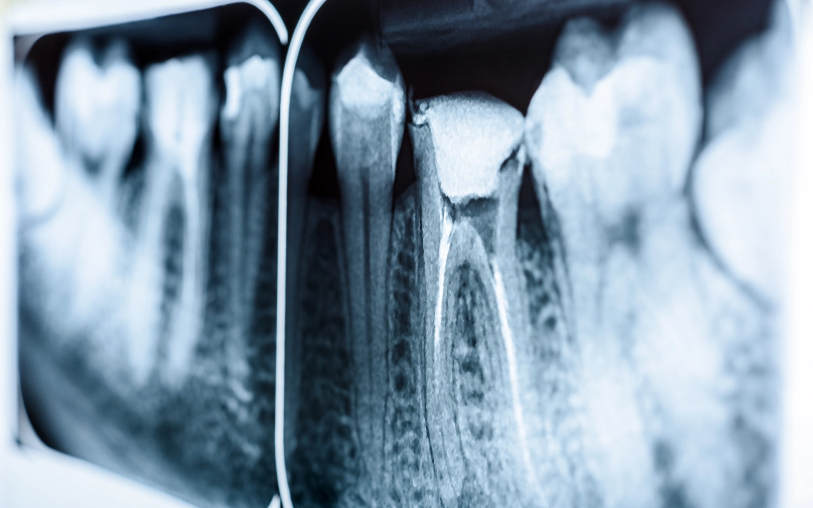 神経を取った歯は「痛みを感じない」からこそ注意が必要