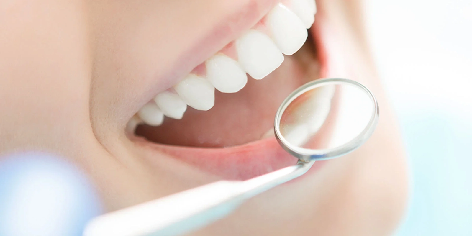 ホワイトニング後のケア